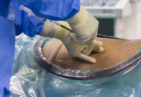 epidural steroid injection