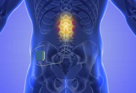 spinal cord stimulation