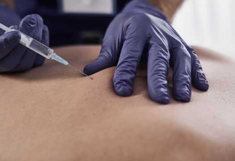 trigger point injections